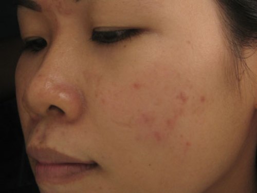 Hãy dùng laser đúng chuẩn để khỏi gặp biến chứng
