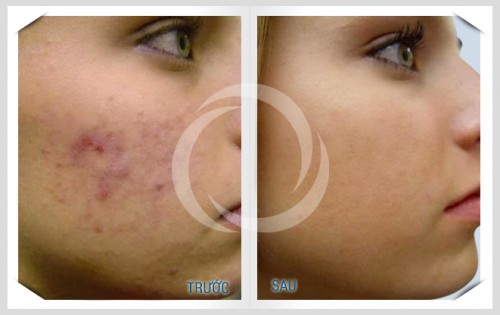 Tổng hợp các cách trị thâm sẹo hiệu quả cho từng loại da 4