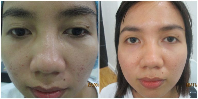 Đánh giá khách hàng điều trị sẹo lồi