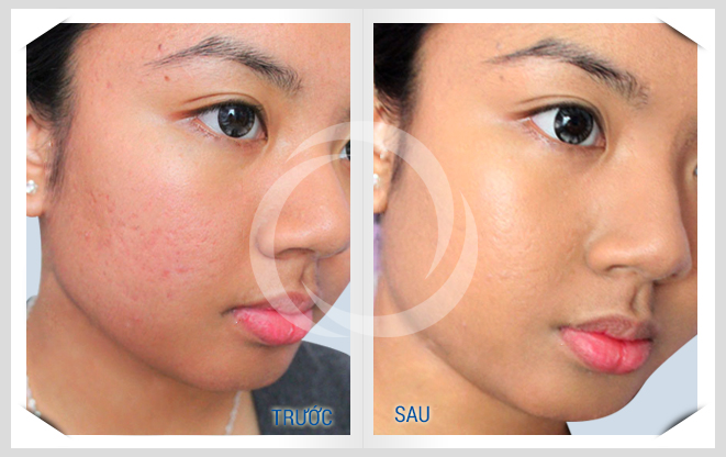 Bí kíp trị sẹo mụn nhanh nhất 4 Bí kíp trị sẹo mụn nhanh nhất 4