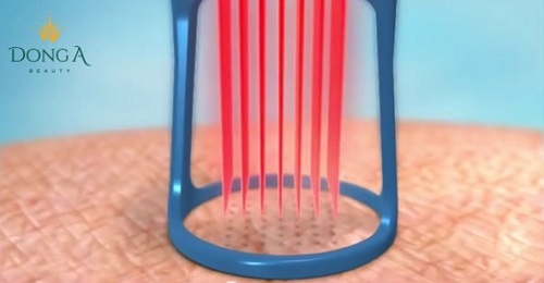 Hệ thống ánh sáng tác động giúp kích thích tăng sinh collagen làm phẳng da