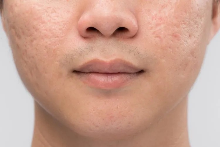 sẹo