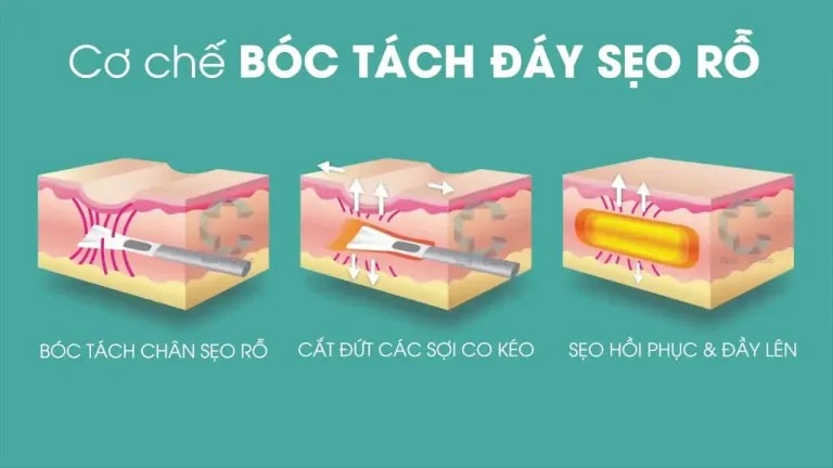 sẹo
